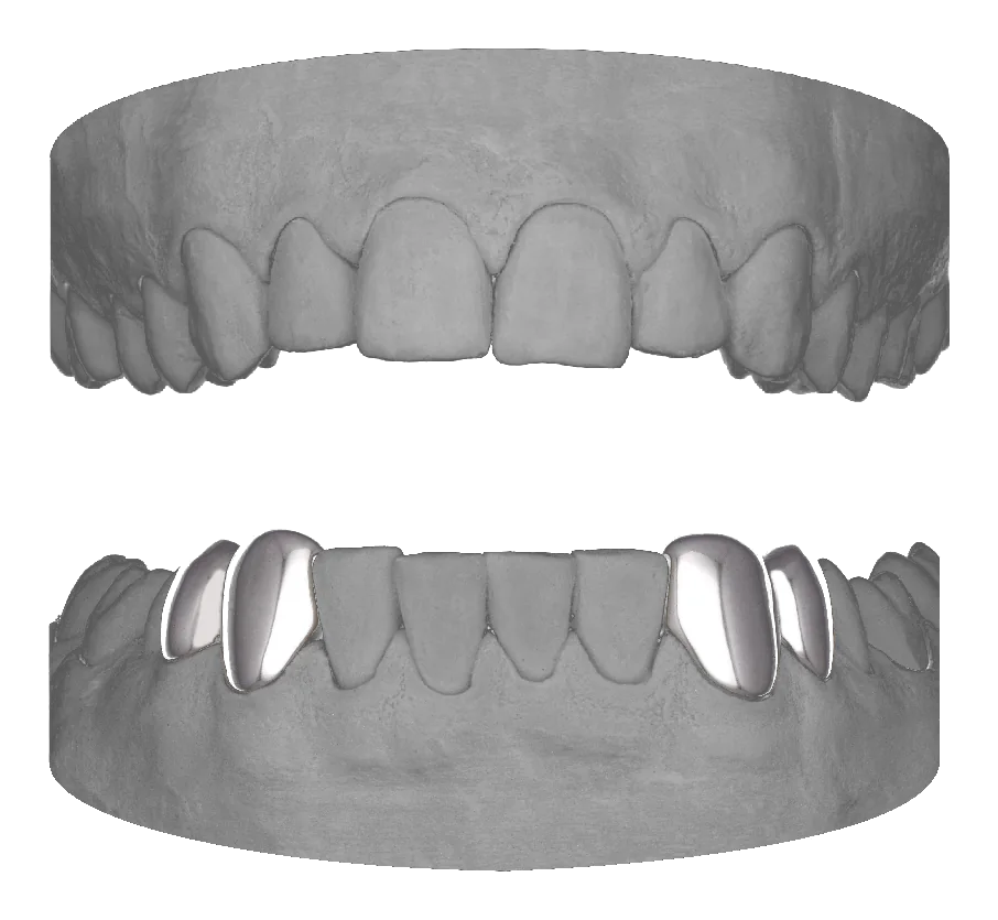 2x Canine Premolar Lower