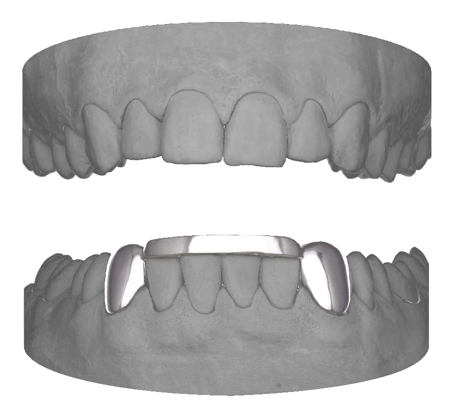 2x Canines and Bar Lower